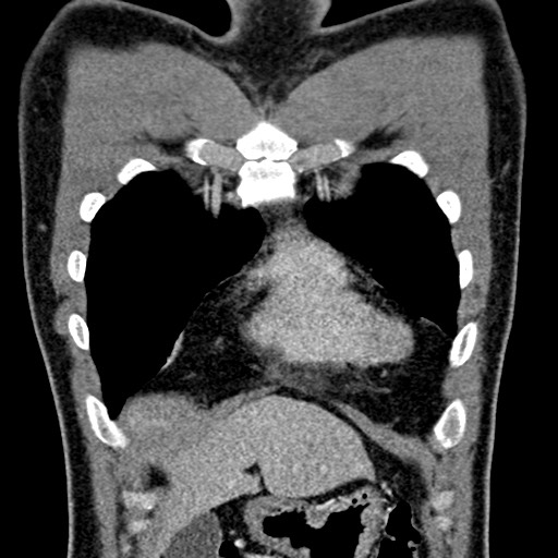 Apical lung mass mimic - neurogenic tumor (Radiopaedia 59918-67521 B 39).jpg