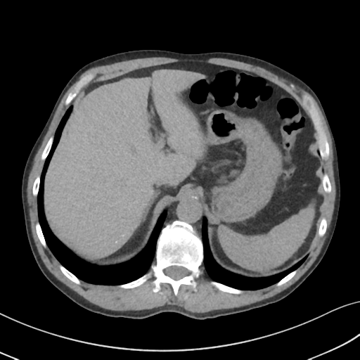 Apical pulmonary metastasis (Radiopaedia 46338-50754 B 59).png