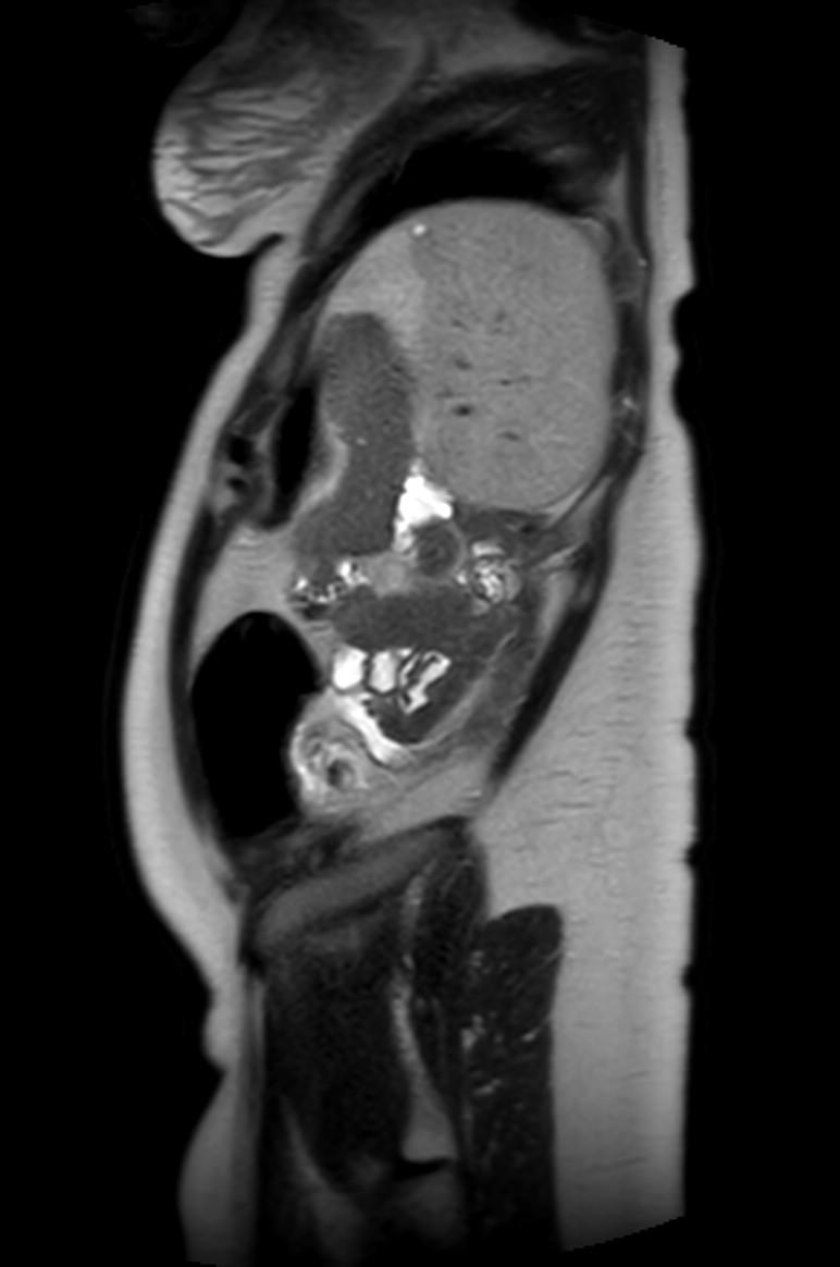 Appendicitis in gravida (MRI) (Radiopaedia 89433-106395 Sagittal T2 11).jpg
