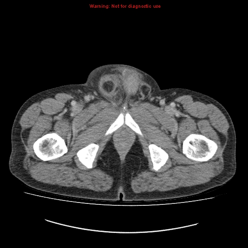 File:Appendicitis mass in inguinal hernia (Radiopaedia 26858-27029 A 35).jpg