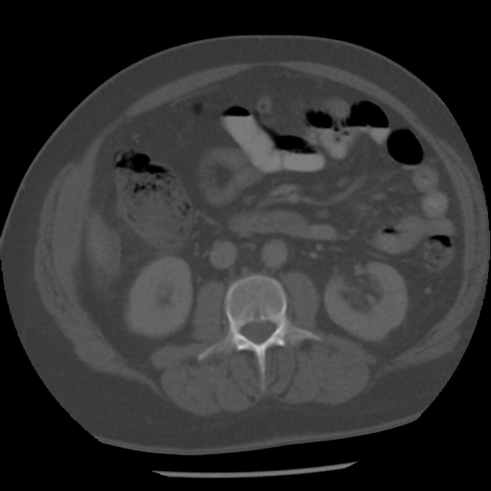 Appendicitis with perforation (Radiopaedia 35790-37342 Axial bone window 24).jpg