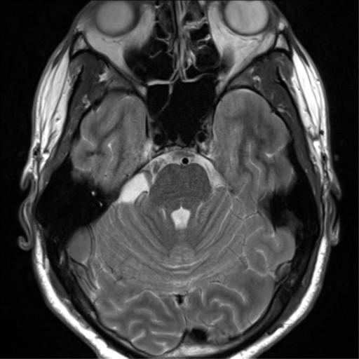File:Arachnoid cyst - cerebellopontine angle (Radiopaedia 59689-67083 Axial T2 17).png