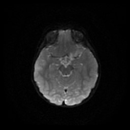 Arachnoid cyst - middle cranial fossa (Radiopaedia 86780-102938 Axial DWI 47).jpg