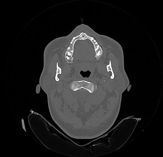 File:Arcuate foramen (Radiopaedia 89833-106944 Axial bone window 45).jpg