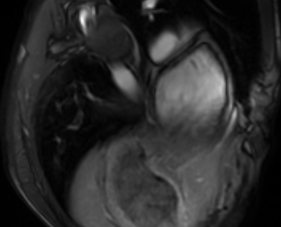 Arrhythmogenic right ventricular cardiomyopathy (Radiopaedia 69564-79464 4ch cine 154).jpg