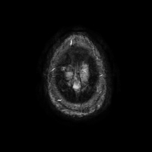 Arteriovenous malformation (Radiopaedia 71628-81999 Axial Gradient Echo 116).jpg