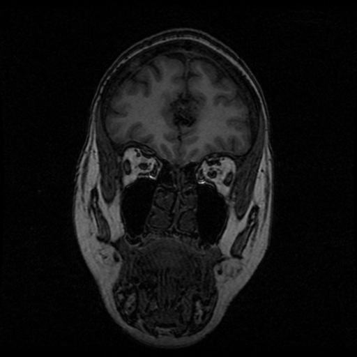 Arteriovenous malformation (cerebral) (Radiopaedia 40070-42580 Coronal T1 49).png