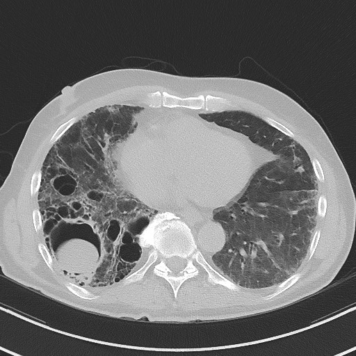 Aspergilloma on background pulmonary fibrosis (Radiopaedia 60942-68757 A 38).jpg