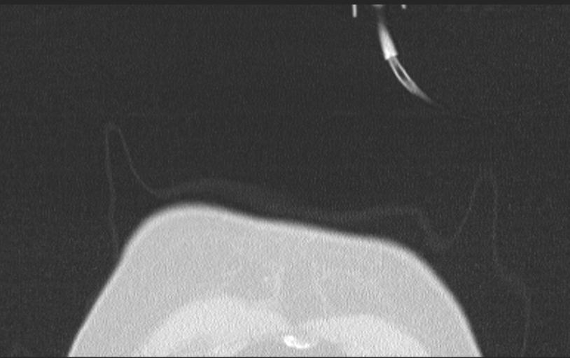 Aspirated tooth (Radiopaedia 28584-28844 Axial lung window 13).jpg