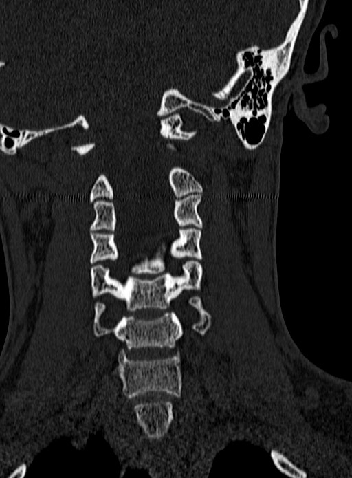 Atlantoaxial subluxation (Radiopaedia 44681-48450 Coronal bone window 71).jpg