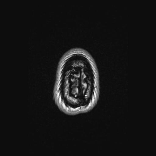 Atretic encephalocoele with inferior vermis hypoplasia (Radiopaedia 30443-31108 Axial 148).jpg