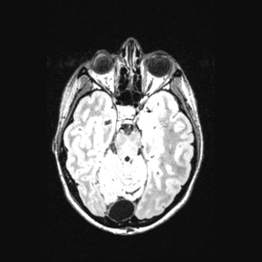 Atretic encephalocoele with inferior vermis hypoplasia (Radiopaedia 30443-31108 Axial 60).jpg