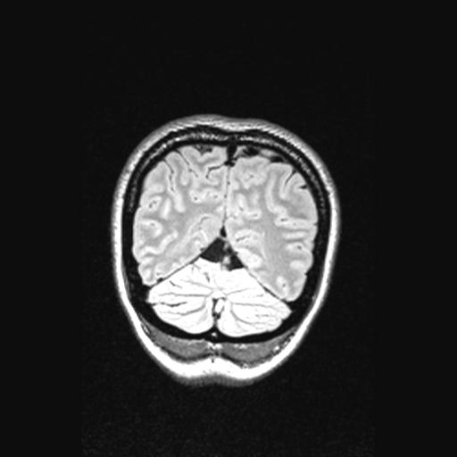Atretic encephalocoele with inferior vermis hypoplasia (Radiopaedia 30443-31108 Coronal FLAIR 37).jpg