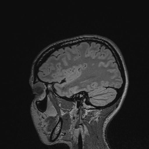 Atretic encephalocoele with inferior vermis hypoplasia (Radiopaedia 30443-31108 Sagittal FLAIR 118).jpg