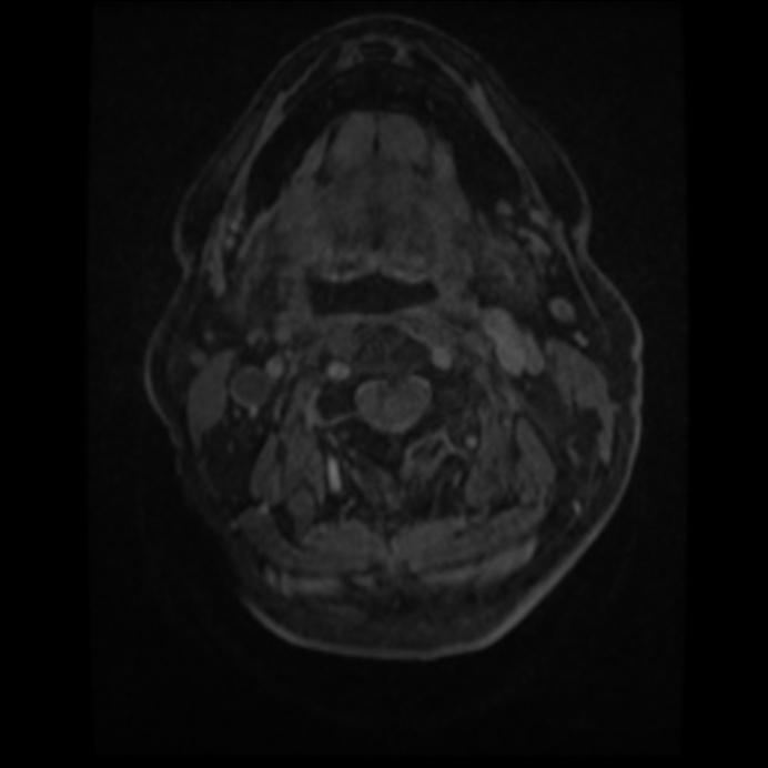 Atypical meningioma (Radiopaedia 45535-49629 Axial T1 C+ 1).jpg