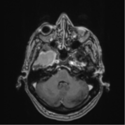 Atypical meningioma (WHO Grade II) (Radiopaedia 54742-60979 Axial T1 C+ 13).png