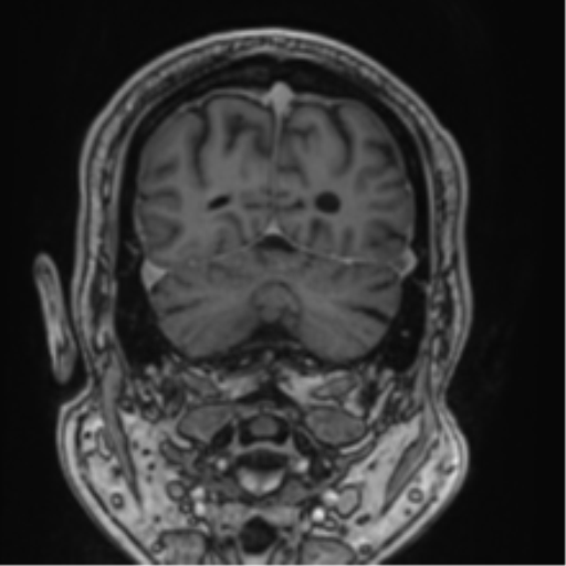 Atypical meningioma (WHO grade II) with brain invasion (Radiopaedia 57767-64729 Coronal T1 C+ 69).png