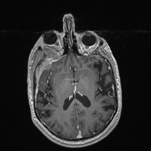 Atypical meningioma (grade II) - en plaque (Radiopaedia 29633-30147 Axial T1 C+ 104).jpg