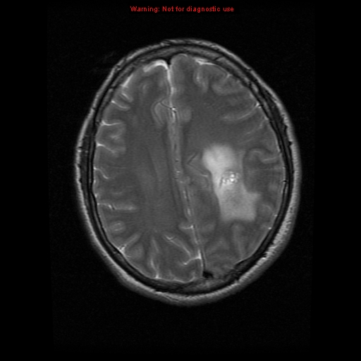 File:Atypical meningioma - grade II (Radiopaedia 13303-13305 Axial T2 15).jpg