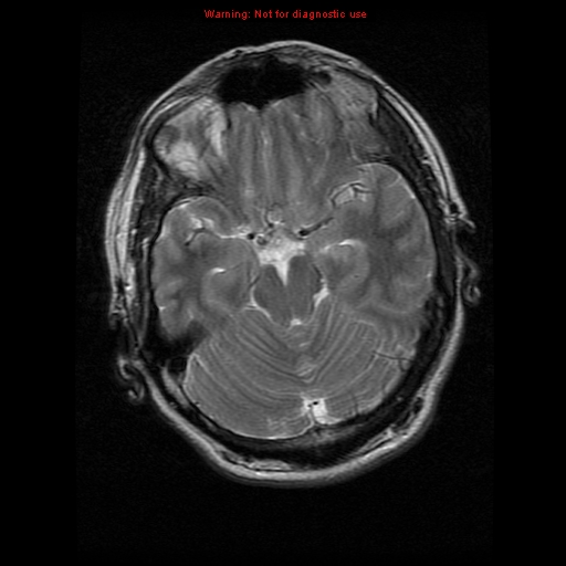 File:Atypical meningioma - grade II (Radiopaedia 13303-13305 Axial T2 8).jpg