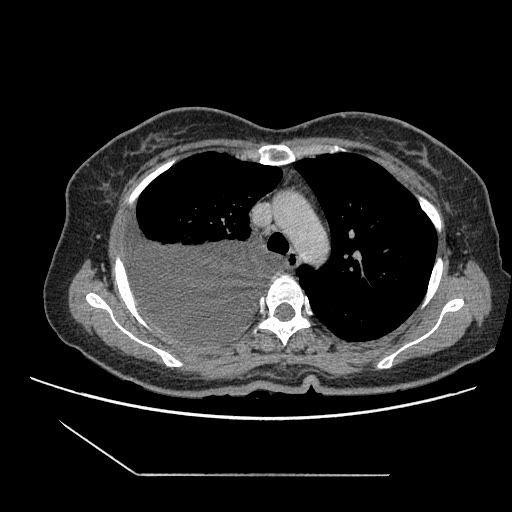 File:Atypical retroperitoneal lymphocoeles with large leiomyoma of uterus (Radiopaedia 32084-33024 A 1).jpg