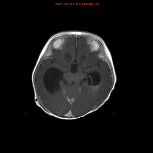 File:Atypical teratoid rhabdoid tumor (Radiopaedia 10712-11183 Axial T1 C+ 11).jpg