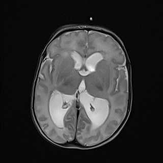 File:Atypical teratoid rhabdoid tumor (prenatal US and neonatal MRI) (Radiopaedia 59091-66388 Axial T2 17).jpg