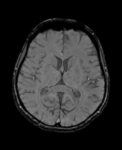 File:Autoimmune limbic encephalitis (Radiopaedia 30363-31005 SWI - magnitude 43).jpg