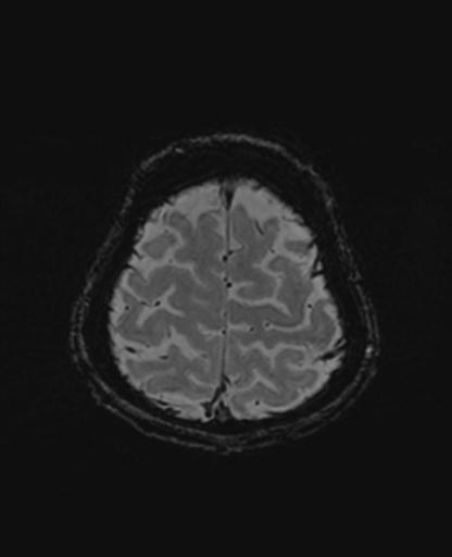 Autoimmune limbic encephalitis (Radiopaedia 30363-31005 SWI 70).jpg