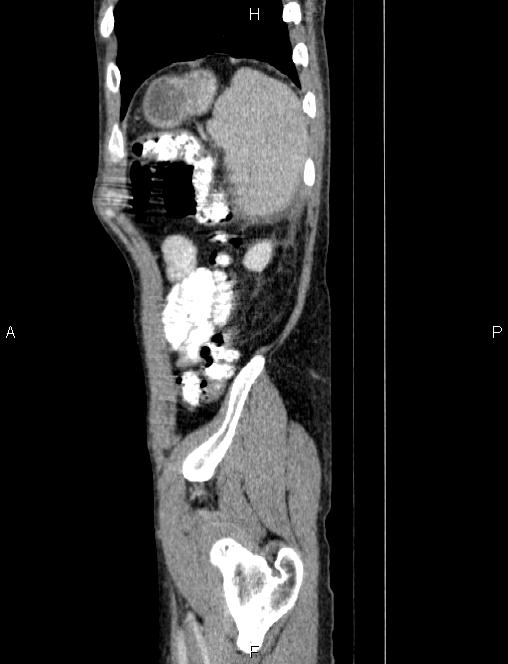 Autoimmune pancreatitis (Radiopaedia 84925-100431 E 85).jpg