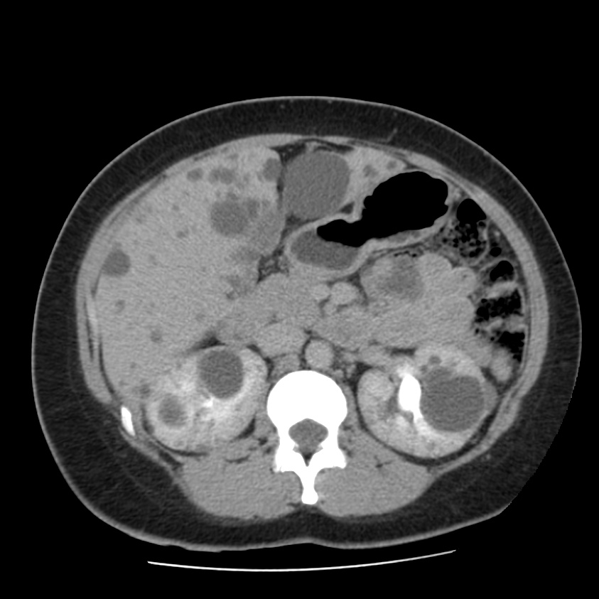 Autosomal dominant polycystic kidney disease (Radiopaedia 23061-23093 C+ delayed 26).jpg