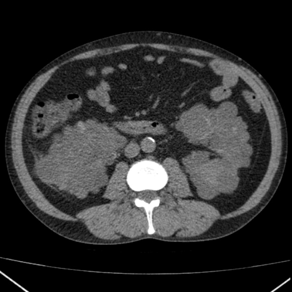 File:Autosomal dominant polycystic kidney disease (Radiopaedia 36539-38101 Axial non-contrast 43).jpg