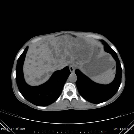 File:Autosomal dominant polycystic kidney disease (Radiopaedia 44122-47684 Axial non-contrast 5).jpg