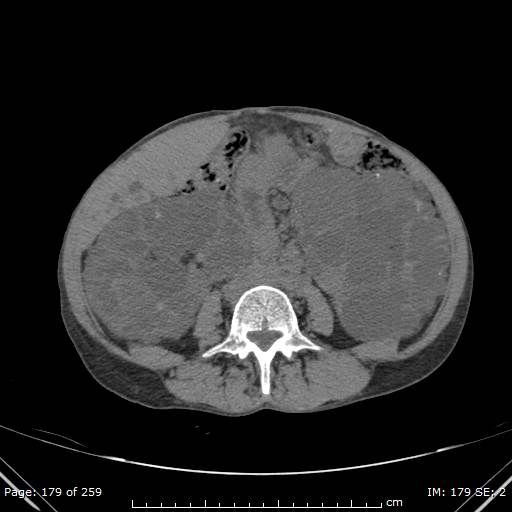 File:Autosomal dominant polycystic kidney disease (Radiopaedia 44122-47684 Axial non-contrast 64).jpg