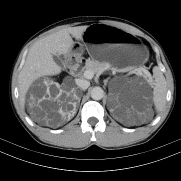 Autosomal dominant polycystic kidney disease (Radiopaedia 66349-75582 B 27).jpg