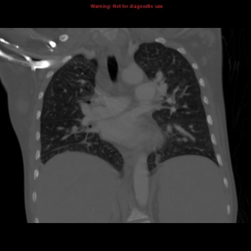 File:Avascular necrosis in sickle cell disease (Radiopaedia 17448-17152 Coronal bone window 69).jpg