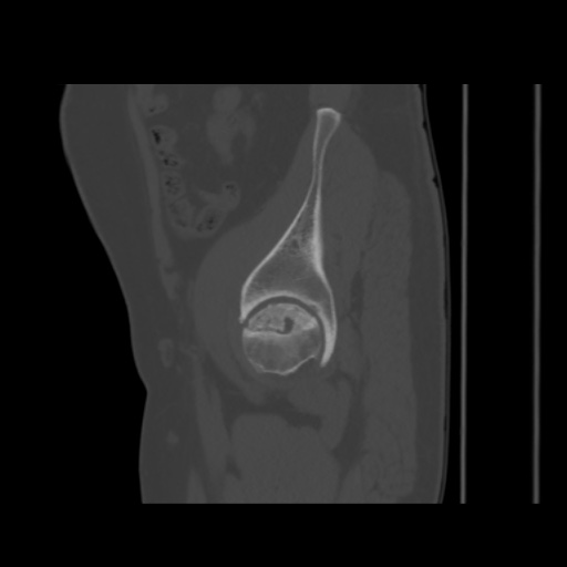 Avascular necrosis of the hip (Radiopaedia 61503-69467 B 15).jpg