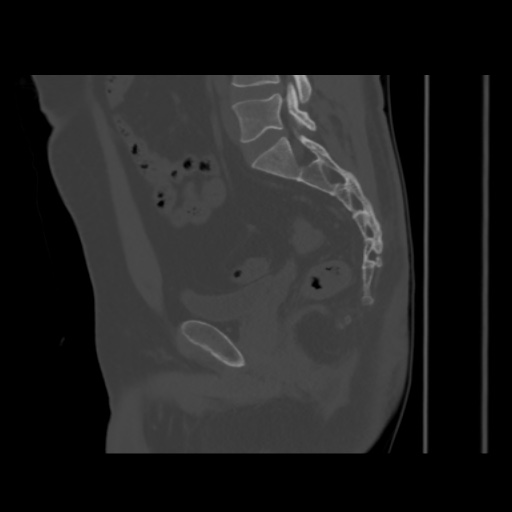 Avascular necrosis of the hip (Radiopaedia 61503-69467 B 33).jpg