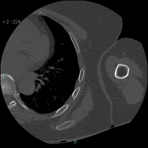 Avascular necrosis of the shoulder - Cruess stage I (Radiopaedia 77674-89887 Axial bone window 56).jpg