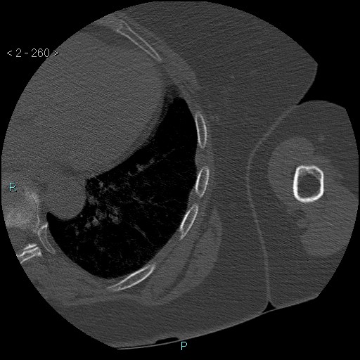 Avascular necrosis of the shoulder - Cruess stage I (Radiopaedia 77674-89887 Axial bone window 65).jpg