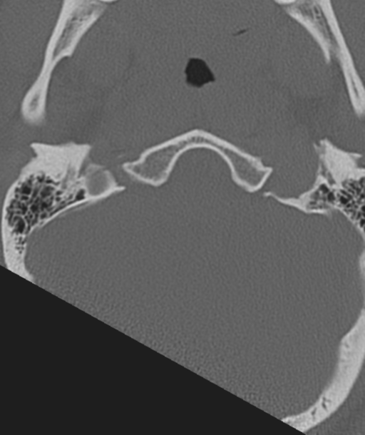 Axis peg fracture (type 3) and atlas lateral mass (type 4) fracture (Radiopaedia 37474-39324 Axial bone window 4).png