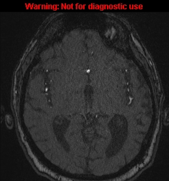 Azygos anterior cerebral artery (Radiopaedia 59325-66677 Axial MRA 81).jpg