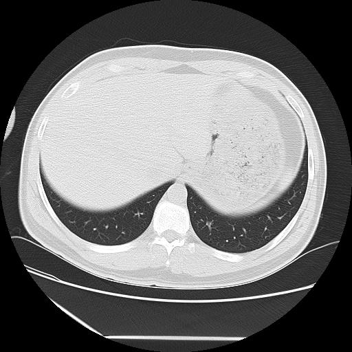 Azygos fissure (Radiopaedia 88181-104784 Axial lung window 48).jpg
