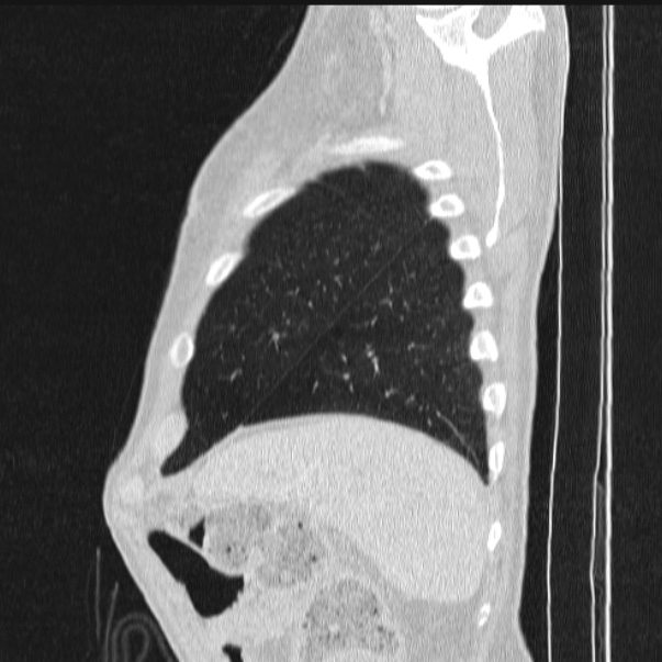 Azygos lobe (Radiopaedia 38259-40275 lung window 87).jpg