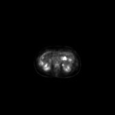 B-cell lymphoma of the mesentery (Radiopaedia 65743-74868 18F-FDG PET-CT 146).jpg