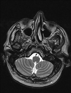 File:Balo concentric sclerosis (Radiopaedia 50458-55940 Axial T2 38).jpg