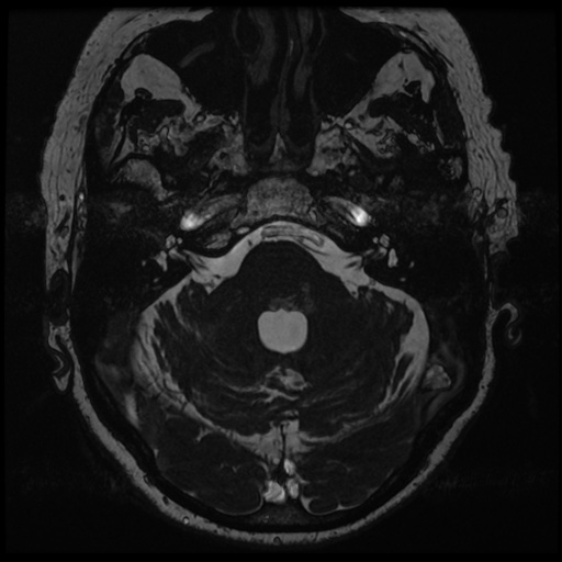 File:Balo concentric sclerosis (Radiopaedia 53875-59982 Axial T2 FIESTA 35).jpg
