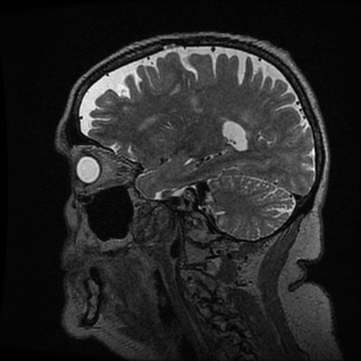 Balo concentric sclerosis (Radiopaedia 53875-59982 Sagittal 3D FSE 186).jpg