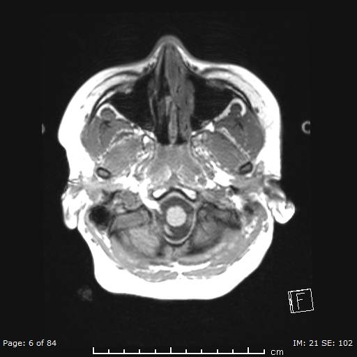 Balo concentric sclerosis (Radiopaedia 61637-69636 Axial T1 6).jpg