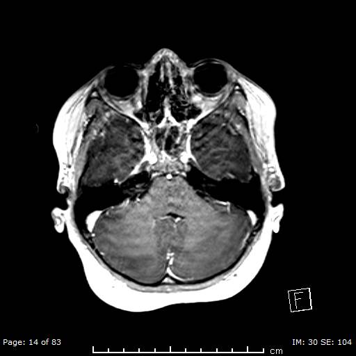 Balo concentric sclerosis (Radiopaedia 61637-69636 Axial T1 C+ 14).jpg